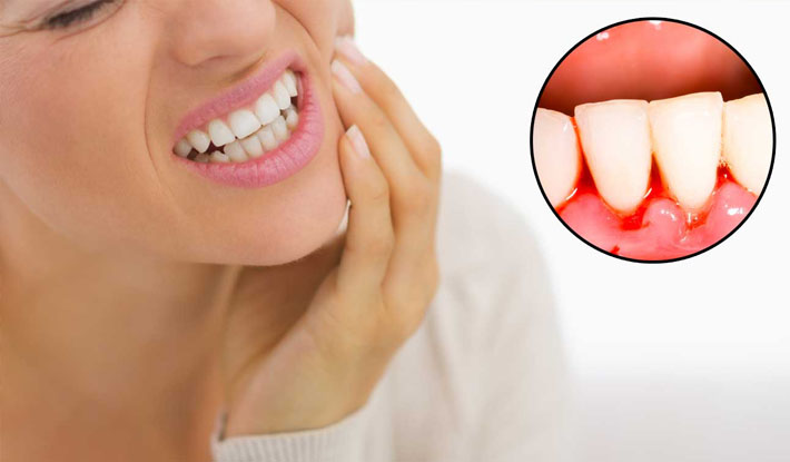 Nguyên nhân và cách điều trị hiệu quả chảy máu chân răng
