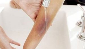 Mẹo hay trị bỏng bằng nguyên liệu thiên nhiên